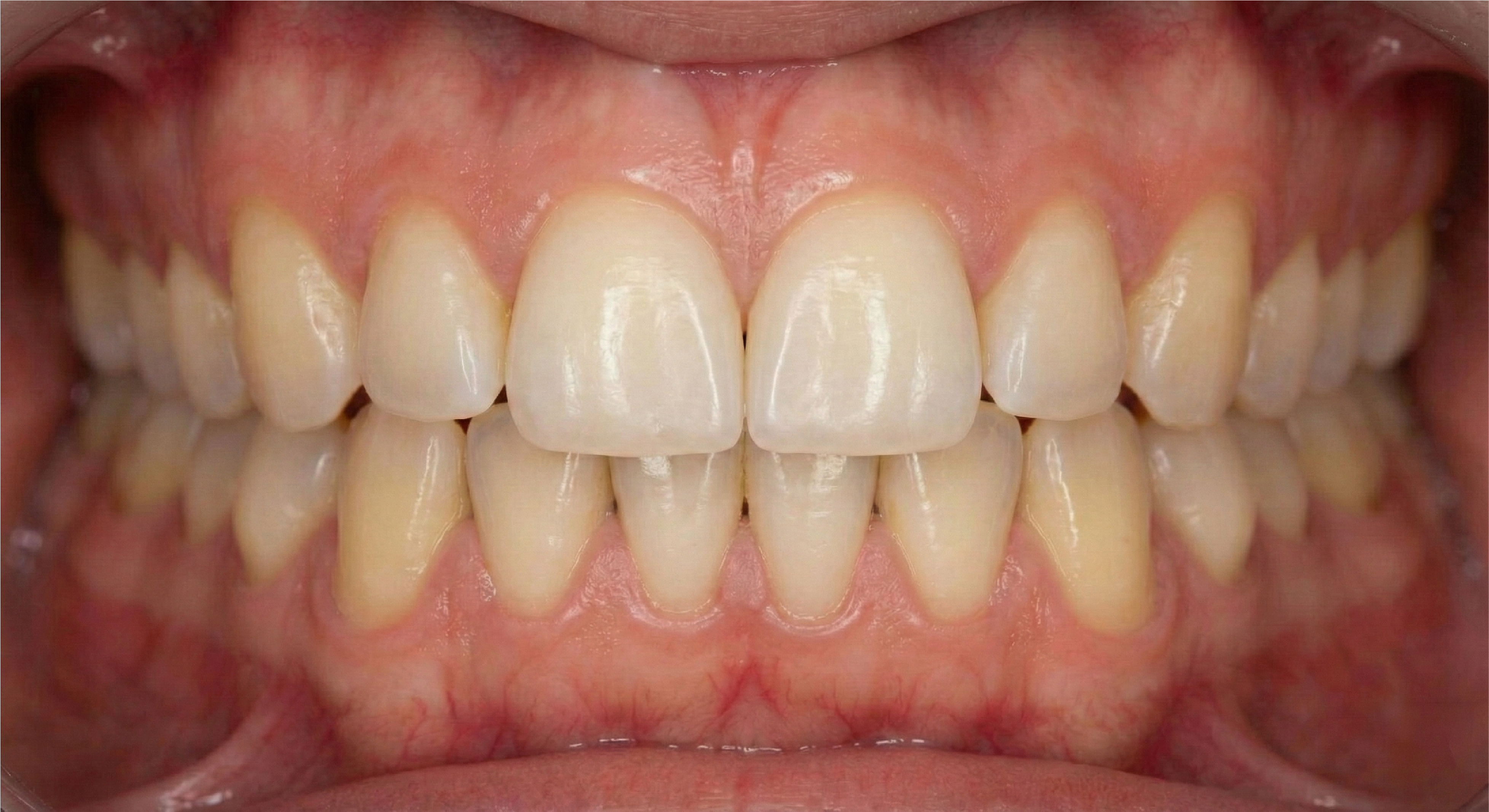 After — Direct Composite Veneers